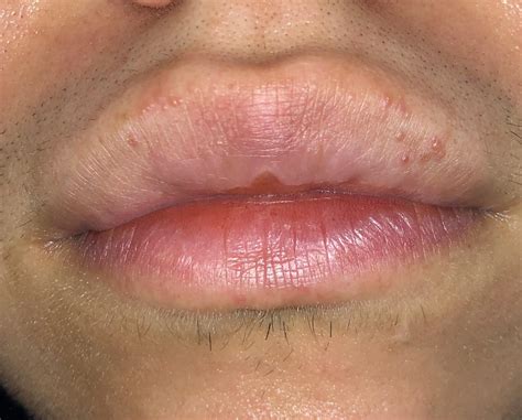 Small Bumps On Lips Please Help Dermatologyquestions