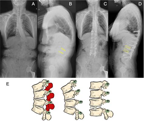 Figure 1 From Trans Intervertebral Osteotomy Classification Of