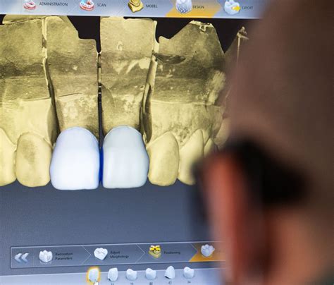 Digital Impressions Dentist Digital Workflow Elite Dental Lab Gold