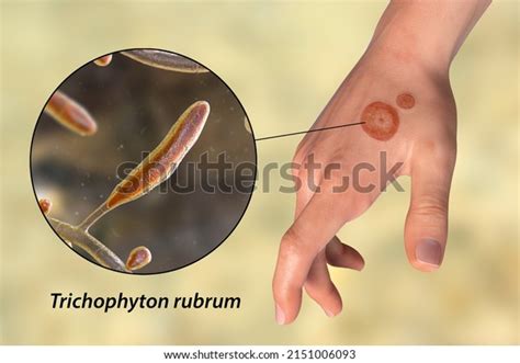 Fungal Infection On Mans Hand Tinea Stock Illustration 2151006093