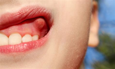 Síntomas Del Absceso Dental Doctores Piña Goyenechea