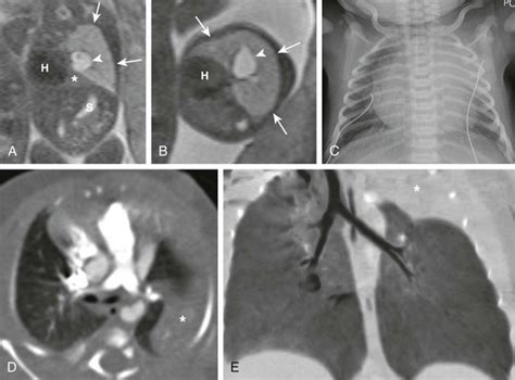 Congenital Lung Anomalies Radiology Key