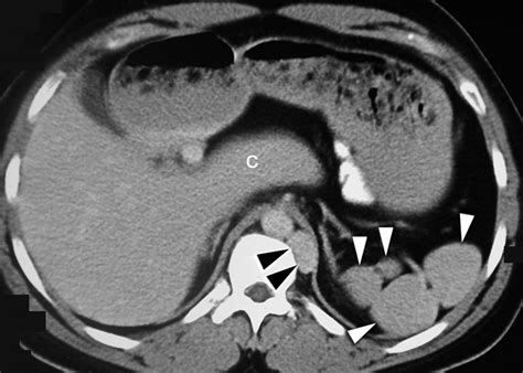 Annular Pancreas And Agenesis Of The Dorsal Pancreas In A Patient With