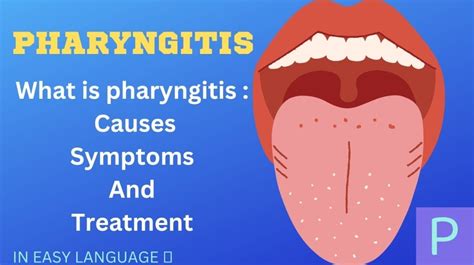 What Is Pharyngitis Causes Symptoms Treatment