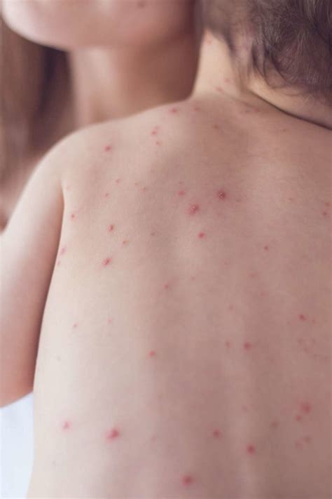 Measles Symptoms And Treatment