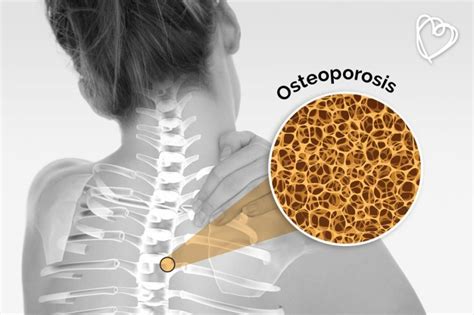 Mujeres Más Propensas A Padecer Osteoporosis Imss
