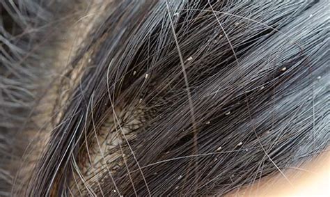 Head Lice And Nits Children And Teens Raising Children Network