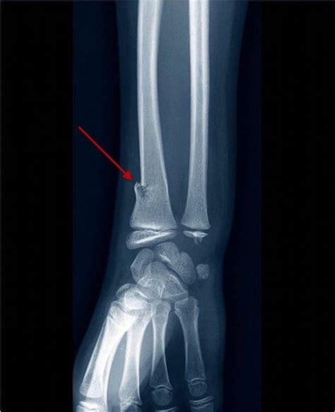 Image Greenstick Fracture Of The Distal Radius Msd Manual