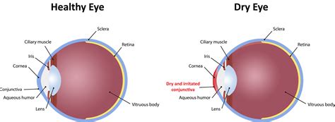 Other associated symptoms include irritation, redness, discharge, and easily fatigued eyes. Dry Eye Syndrome - Sandhurst Eye Centre