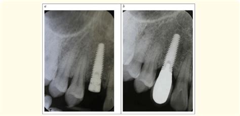 Radiographic Images Of 13 Implant Immediately After Implant Placement