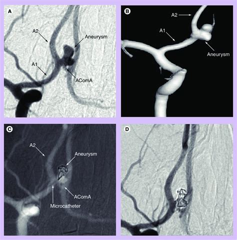 Recently Ruptured Saccular Anterior Communicating Artery Aneurysm