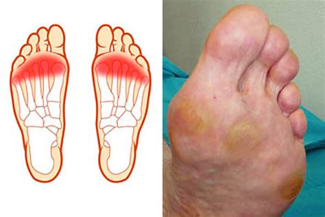Metatarsal Pads Metatarsalgia Ball Of Foot Pain Vive Health