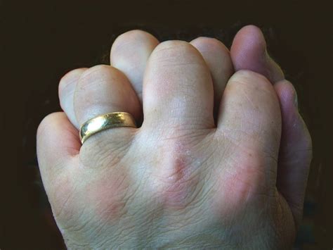 cracking your knuckles does not cause arthritis