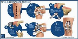 Total Knee Replacement Surgery Mountsinai Org Everything