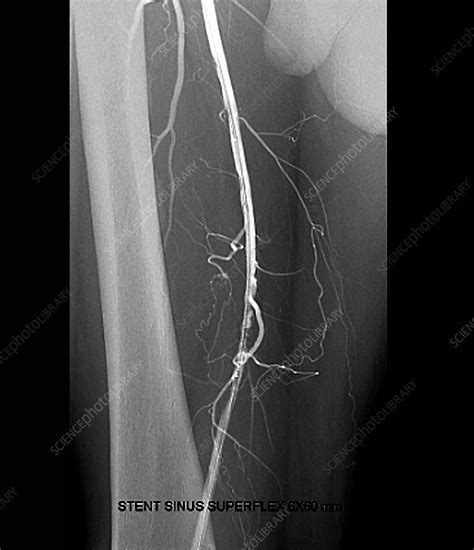 Leg Artery Angioplasty Angiogram Stock Image C0489310 Science