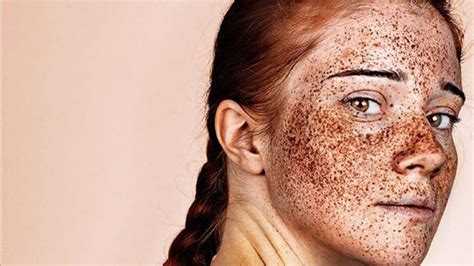 Freckles Photographer Shines Spotlight On The Beauty Of Spots Freckles Girl Freckles Beauty
