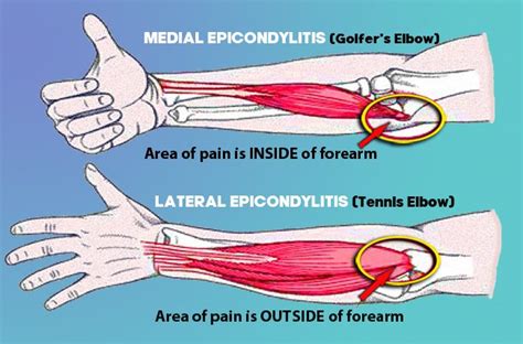 Spring Cleaning Taking Care To Prevent Or Address Elbow Injury