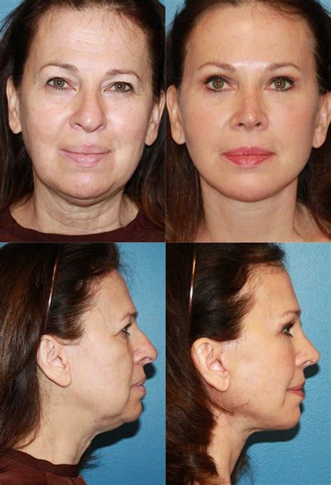 Facelift Surgery And Mini Petit Facelift San Diego Before And After