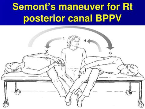 Ppt Bppv And Vestibular Neuronitis Powerpoint