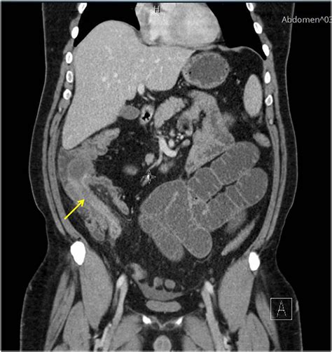 Coronal Ct Scan With Intravenous Contrast Demonstrating The