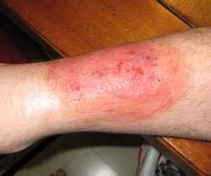 We call this type of skin infection. What Does a Spider Bite Look Like? How to Identify a ...