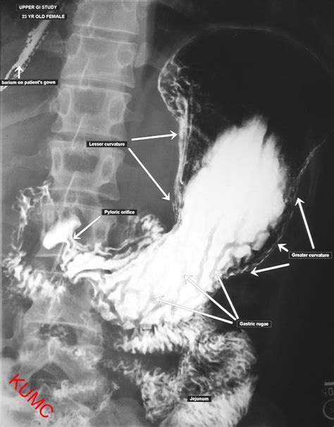 Ugi From Ku Radiographic Anatomy Radiology Student Radiology Imaging