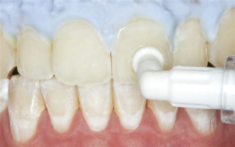 Icon Kariesinfiltrant Vestibular Dmg Hochwertige Dentalmaterialien