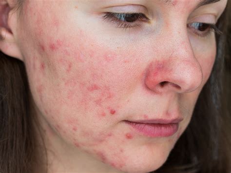 Minocycline Extended Release Vs Doxycycline For Rosacea Dermatology