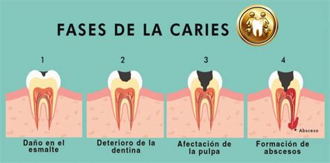 Fases De La Caries ClÍnica Dental Ortodent Magazine