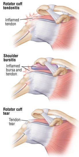 Rotator Cuff Injury Guide Causes Symptoms And Treatment Options In