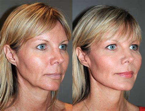 Before And 1 Day After Age 48 Y Lift Accentuated The Cheekbones
