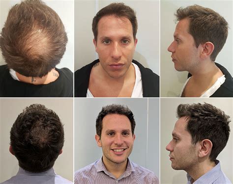 Fue Hair Transplant Procedure Review Video Diary Before And After