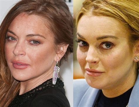 Lindsay Lohan Before And After Plastic Surgery