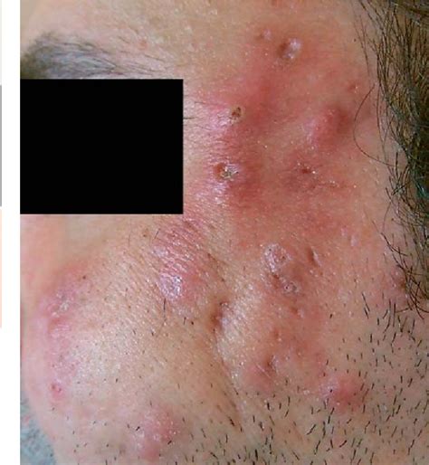 Figure 2 From Back And Face Involvement In Hidradenitis Suppurativa