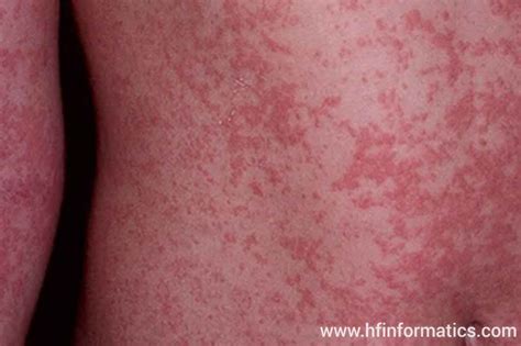 Maculopapular Rash Pictures Symptoms Causes And Treatment