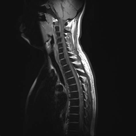 Thalassemia: spine MRI | Image | Radiopaedia.org