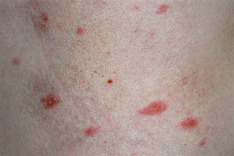 Pityriasis Rosea In Children Symptoms Causes And Treatment