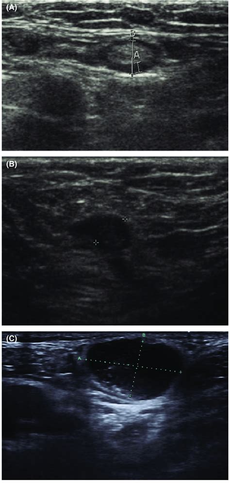 Groin Lymph Nodes Ultrasound