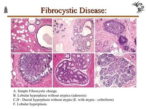 Ppt Pathology Of Breast Disorders Powerpoint Presentation Free