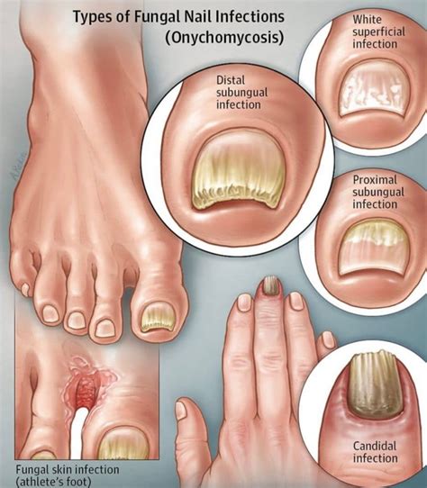 Tips For Treating Fungal Nail Infections The Footcare Clinic