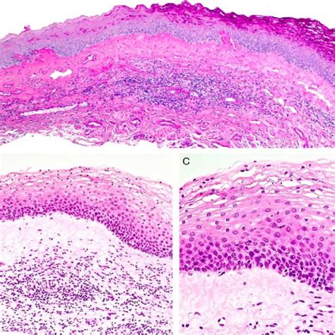 Biopsy Of Pallor At Vestibule Consistent With Lichen Sclerosus A