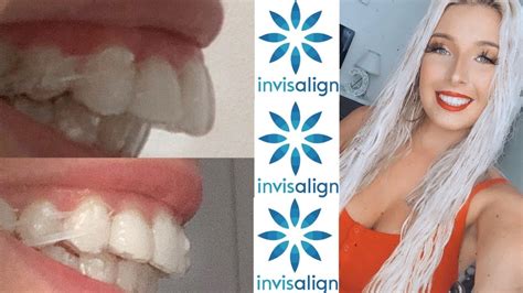 Invisalign Overbite Correction Month Update With Before And After