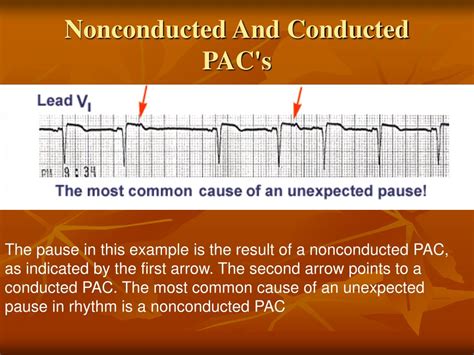 Ppt Electrocardiogram Powerpoint Presentation Free Download Id297761
