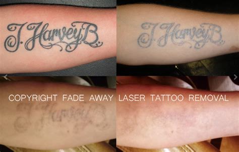 Compare laser tattoo removal perth contents soulution ink learn fillers top. Fade Away Laser Tattoo Removal in Duluth, MN | Whitepages