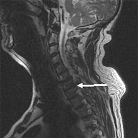 Ein mrt lws mit verdacht auf einen akuten bandscheibenvorfall wurde in die wege geleitet. Klinik und Poliklinik fuer Neurochirurgie: Halswirbelsäule
