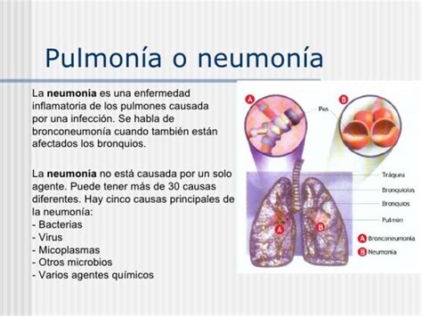 Cuadros Comparativos Entre Pulmonía Y Bronquitis Cuadro Comparativo