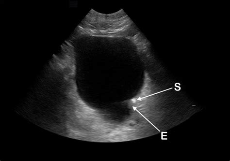 Bladder Bulge Unifying Old And New Sonographic Bladder Wall