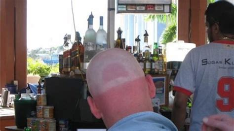 22 People Living With The World S Most Awkward Sun Tan Line Fails EVER