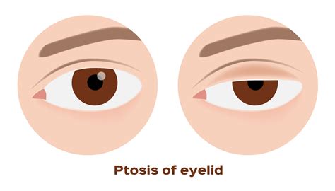 Ptosis Causes Symptoms Treatment Sunnyside Eye Doctor