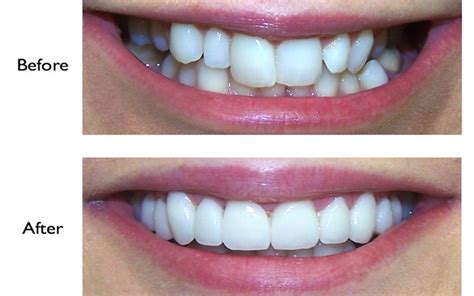 Smile Makeover Dr Kamals Dental Clinic